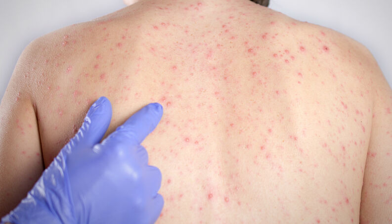 Campanha contra sarampo terá dia de mobilização